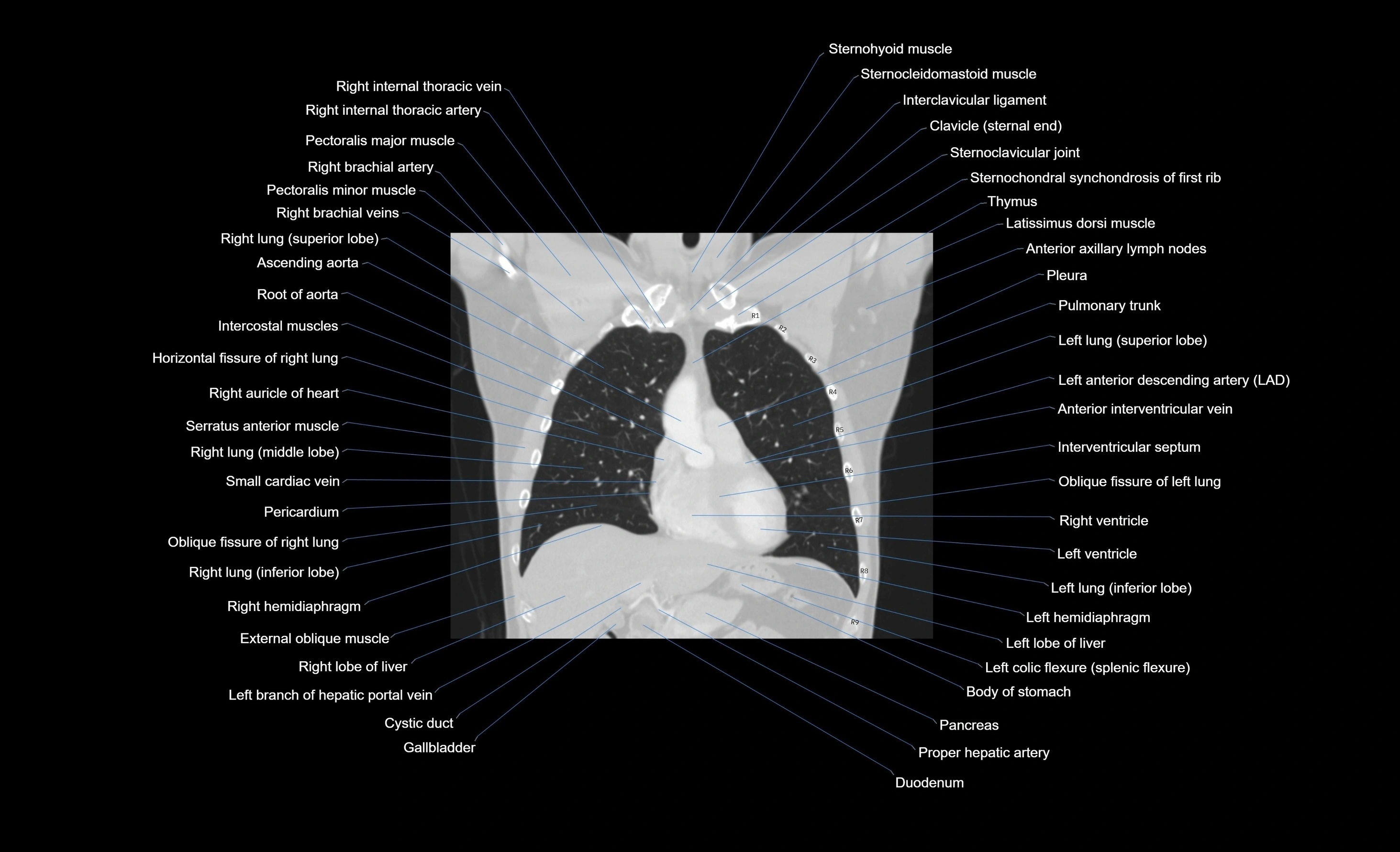 CT chest (thorax) lung window window labelled coronal cross sectional anatomy radiology image-00080.webp